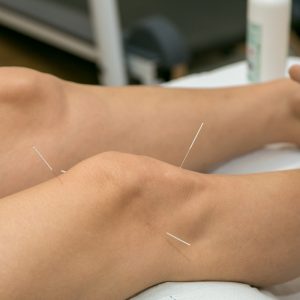 Acupuncture on the knee, treatment of osteoarthritis in the knee for rehabilitation