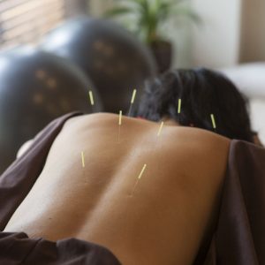 acupuncture